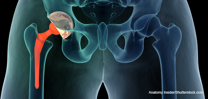 hip replacement